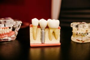 implante dental