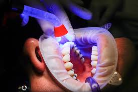 blanqueamiento dental